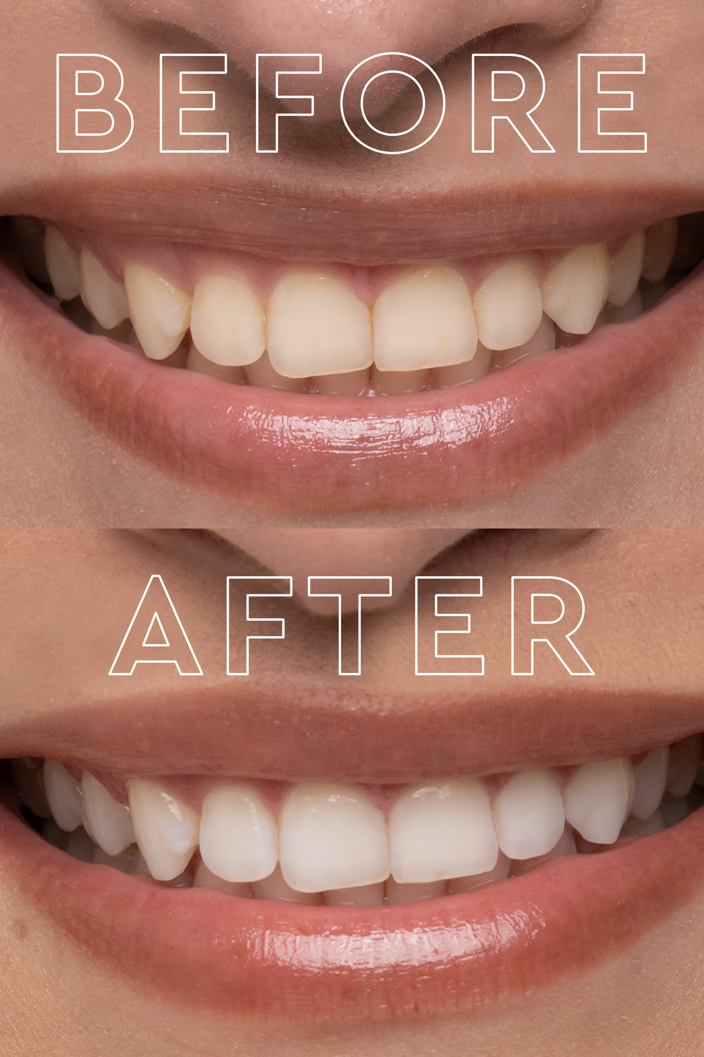 The Teeth Whitening Device