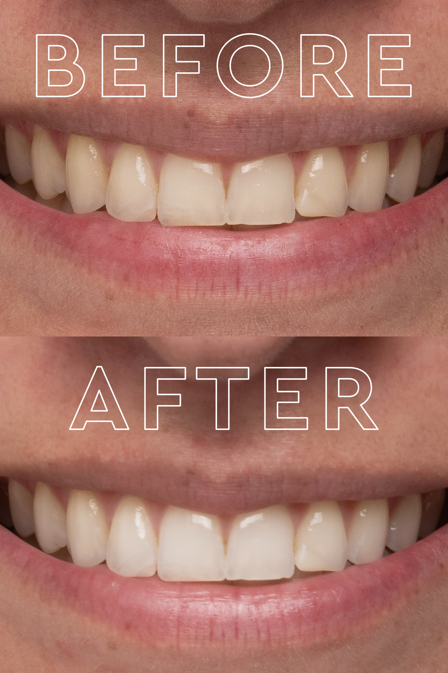 The Teeth Whitening Device